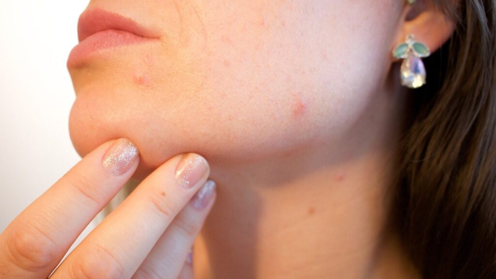 How Can I Stop Pimples on My Face Permanently