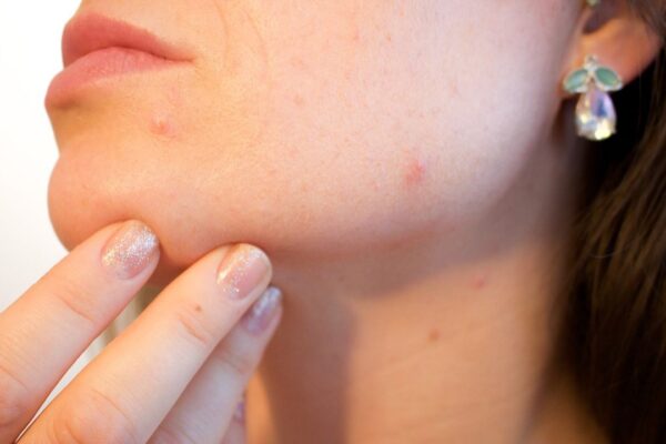 How Can I Stop Pimples on My Face Permanently | womenluxlife.com