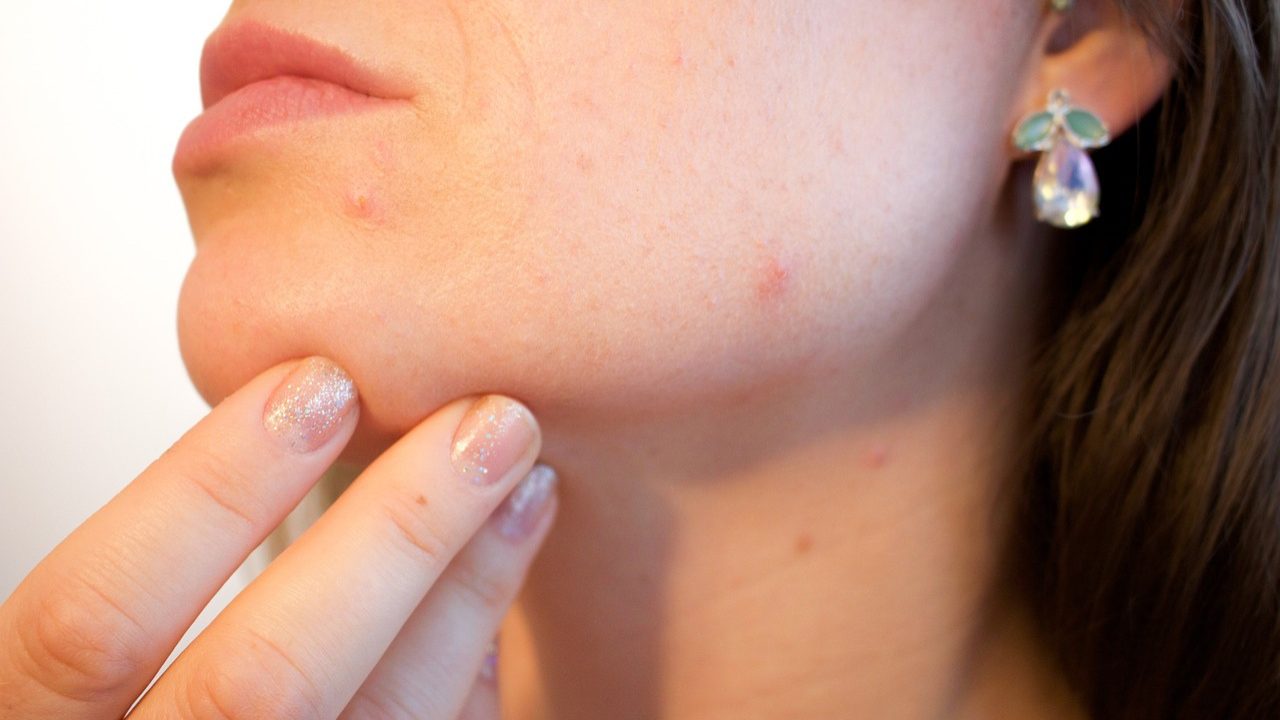 How Can I Stop Pimples on My Face Permanently | womenluxlife.com