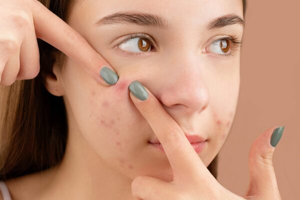 Is Retinol Good For Hormonal Acne | retinol cream for acne side effects